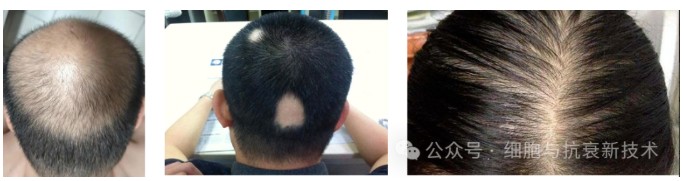 干細胞外泌體在生發(fā)領域的應用